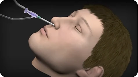 Balloon Sinus