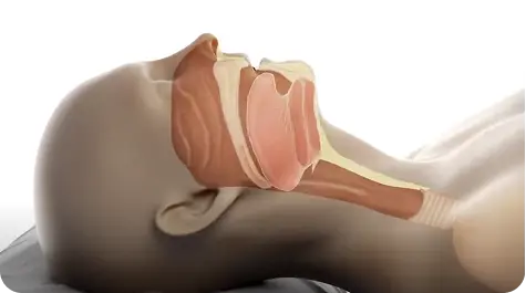 Sleep Apnea